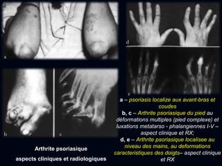 Arthrite psoriasique
aspects cliniques et radiologiques
a – psoriasis localize aux avant-bras et
coudes
b, c – Arthrite psoriasique du pied au
déformations multiples (pied complexe) et
luxations metatarso - phalangiennes I-V –
aspect clinique et RX;
d, e – Arthrite psoriasique localisee au
niveau des mains, au deformations
caracteristiques des doigts– aspect clinique
et RX
a
b c
d
e
 