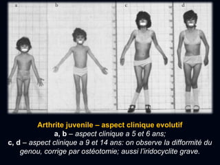 Arthrite juvenile – aspect clinique evolutif
a, b – aspect clinique a 5 et 6 ans;
c, d – aspect clinique a 9 et 14 ans: on observe la difformité du
genou, corrige par ostéotomie; aussi l’iridocyclite grave.
a b c d
 