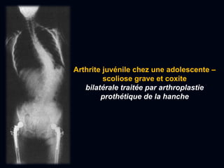 Arthrite juvénile chez une adolescente –
scoliose grave et coxite
bilatérale traitée par arthroplastie
prothétique de la hanche
 
