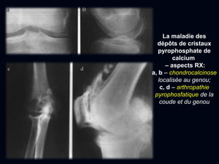 c d
La maladie des
dépôts de cristaux
pyrophosphate de
calcium
– aspects RX:
a, b – chondrocalcinose
localisée au genou;
c, d – arthropathie
pyrophosfatique de la
coude et du genou
 