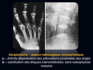 Alcaptonurie – aspect radiologique caracteristique:
a – Arthrite dégénérative des articulations proximales des doigts;
b – calcification des disques intervertébrales, sans osteophytose
massive
 