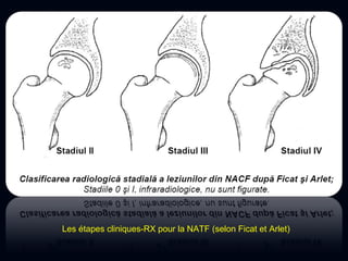 Les étapes cliniques-RX pour la NATF (selon Ficat et Arlet)
 