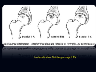 La classification Steinberg – stage II RX
 
