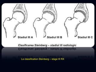 La classification Steinberg – stage III RX
 