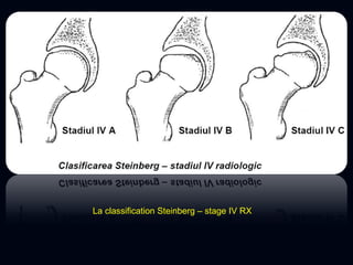 La classification Steinberg – stage IV RX
 