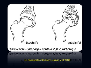 La classification Steinberg – stage V et VI RX
 