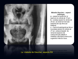 La maladie de Gaucher, aspects RX
 