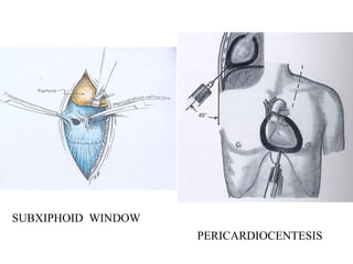 SUBXIPHOID WINDOW
PERICARDIOCENTESIS
 