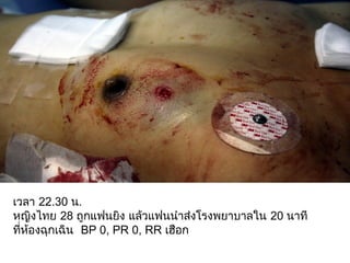 เวลา 22.30 น.
หญิงไทย 28 ถูกแฟนยิง แล้วแฟนนำาส่งโรงพยาบาลใน 20 นาที
ที่ห้องฉุกเฉิน BP 0, PR 0, RR เฮือก
 