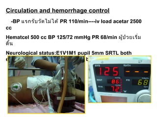 Circulation and hemorrhage control
-BP แรกรับวัดไม่ได้ PR 110/min----iv load acetar 2500
cc
Hematcel 500 cc BP 125/72 mmHg PR 68/min ผู้ป่วยเริ่ม
ดิ้น
Neurological status:E1V1M1 pupil 5mm SRTL both
eye----E1VTM4 pupil 3mm SRTL both eye
 