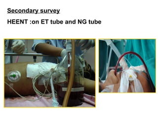 Secondary survey
HEENT :on ET tube and NG tube
 