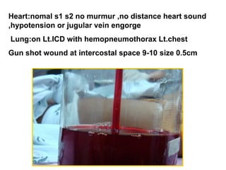 Heart:nomal s1 s2 no murmur ,no distance heart sound
,hypotension or jugular vein engorge
Lung:on Lt.ICD with hemopneumothorax Lt.chest
Gun shot wound at intercostal space 9-10 size 0.5cm
 
