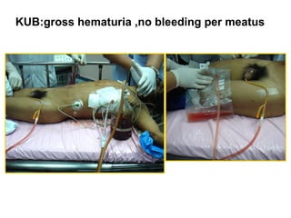 KUB:gross hematuria ,no bleeding per meatus
 