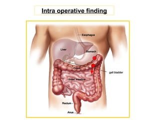 Intra operative finding
 