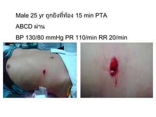 Male 25 yr ถูกยิงที่ท้อง 15 min PTA
ABCD ผ่าน
BP 130/80 mmHg PR 110/min RR 20/min
 