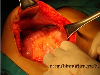 กระสุนไม่ทะลุอวัยวะภายใน
 