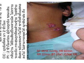 ผู้ป่วยชายไทยอายุ19ปี
CC:ถูกยิงที่คอมา2ชั่วโมง
PI:2ชั่วโมงก่อนผู้ป่วยถูกยิงขณะเดิน
กลับบ้านได้ยินเสียงปืนหลายนัดไม่ทราบ
ระยะยิงกระสุนถูกที่คอด้านซ้ายไหล่ซ้าย
ล้มลงขยับแขนขาไม่ได้ชาทั้งตัวตั้งแต่คอ
ลงไปไม่สามารถพูดได้ญาตินำาส่งถึง
รพ.เอกชน15นาทีหลังเกิดเหตุ
BP 88/56 mmHg, HR 92/min
RR 22/min ,BT 37oC, O2sat 100
 