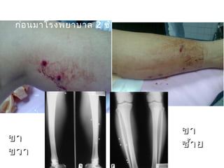 ชายไทยอายุ 21 ปี ถูกยิง 1 ครั้ง ที่ขา 2 ขา
ก่อนมาโรงพยาบาล 2 ชั่วโมง
ขาขา
ขวาขวา
ขาขา
ซ้ายซ้าย
 