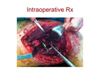 Intraoperative Rx
 