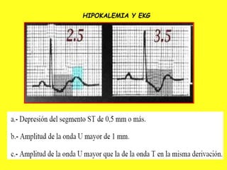 HIPOKALEMIA Y EKG
 