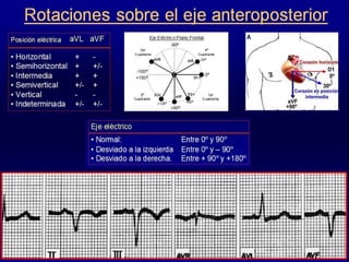 CASO CLINICO
A 72-year-old woman has new-onset atrial flutter with a
ventricular rate of 150/min. She is hemodynamically s...