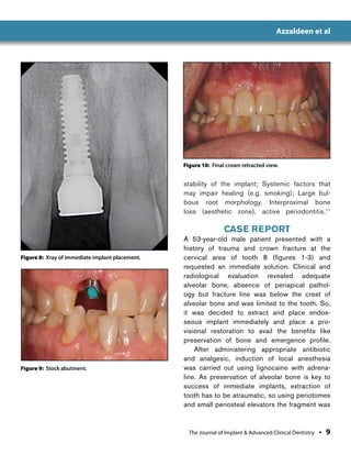 Immediate Implant Placement | PDF
