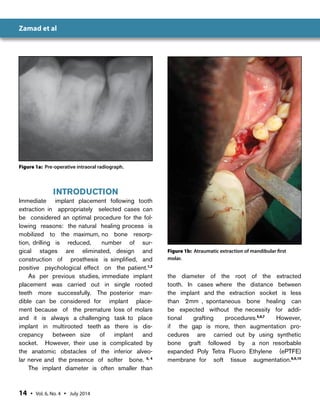 Immediate Implant Placement | PDF