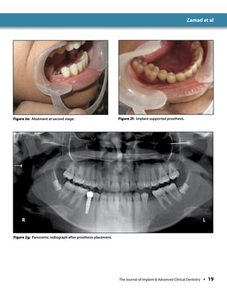 Immediate Implant Placement | PDF