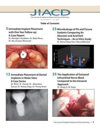 Immediate Implant Placement | PDF