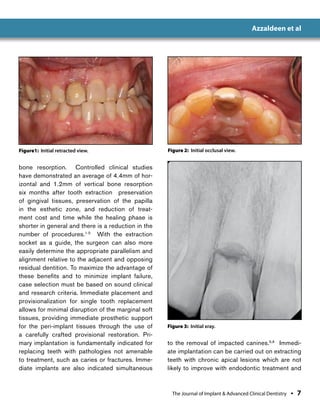 Immediate Implant Placement | PDF