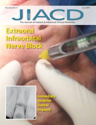 The Journal of Implant & Advanced Clinical Dentistry
Volume 6, No. 4	 July 2014
Extraoral
Infraorbital
Nerve Block
Immediate
Anterior
Dental
Implant
 