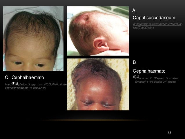 Résultat de recherche d'images pour "Caput Succedaneum and Cephalhematoma"