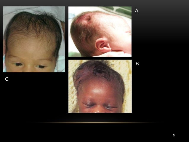 caput succedaneum