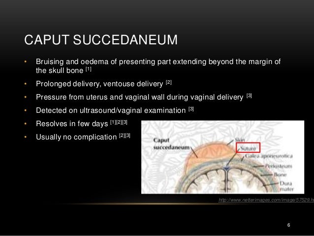 caput succedaneum