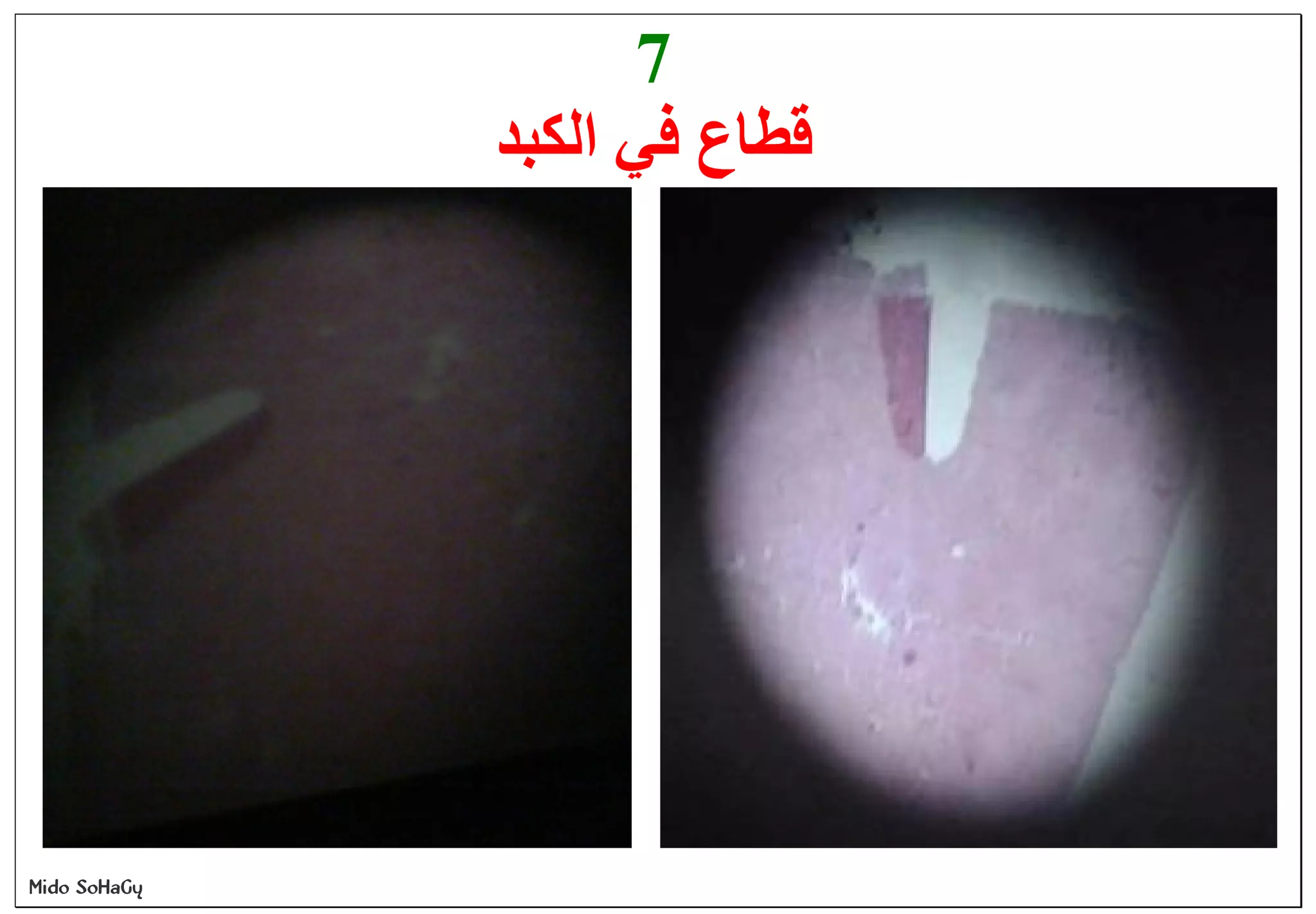 Mido SoHaGy
7
‫اﻟﻜﺒﺪ‬ ‫ﻓﻲ‬ ‫ﻗﻄﺎع‬
 