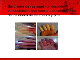 • Síndrome de raynaud: un desorden 
vasoespástico que causa la decoloración 
de los dedos de las manos y pies 
