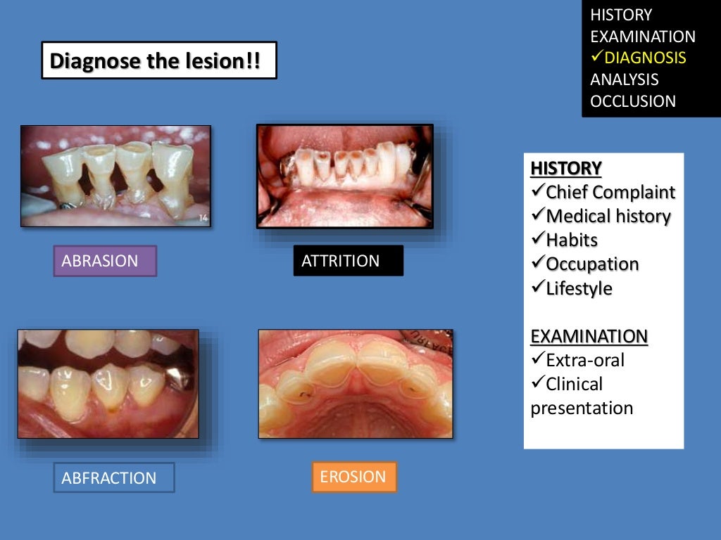 2.diagnosis restoration of worn dentition