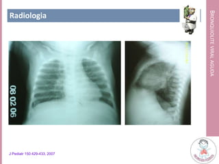 BRONQUIOLITEVIRALAGUDA
Radiologia
J Pediatr 150:429-433, 2007
 