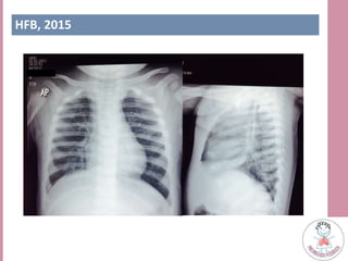 HFB, 2015
 