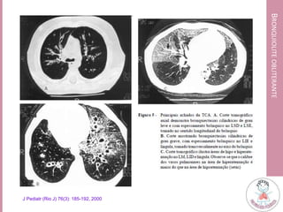 BRONQUIOLITEOBLITERANTE
J Pediatr (Rio J) 76(3): 185-192, 2000
 