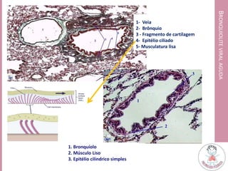 1- Veia
2- Brônquio
3 - Fragmento de cartilagem
4- Epitélio ciliado
5- Musculatura lisa
BRONQUIOLITEVIRALAGUDA
1. Bronquíolo
2. Músculo Liso
3. Epitélio cilíndrico simples
 