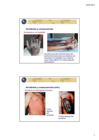 18/02/2015
7
13
•Accidentes y consecuencias
Accidente en un irradiador
Las piernas de dos hombres fueron tan
severamente lesionadas que debieron ser
amputadas. El trabajador que recibió la
mayor dosis falleció 6½ meses después
del accidente.
14
•Accidentes y consecuencias (cont.)
Accidente en Radiografía Industrial.
15 días después del
accidente
6 días
después
del
accidente
 