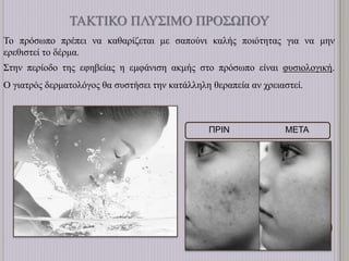 ΤΑΚΤΙΚΟ ΠΛΥΣΙΜΟ ΠΡΟΣΩΠΟΥ
Το πρόσωπο πρέπει να καθαρίζεται με σαπούνι καλής ποιότητας για να μην
ερεθιστεί το δέρμα.
Στην περίοδο της εφηβείας η εμφάνιση ακμής στο πρόσωπο είναι φυσιολογική.
Ο γιατρός δερματολόγος θα συστήσει την κατάλληλη θεραπεία αν χρειαστεί.
ΠΡΙΝ ΜΕΤΑ
 