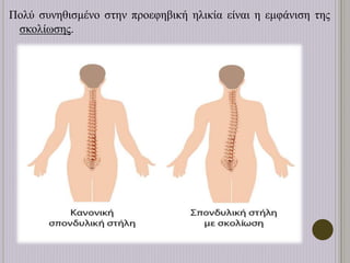 Πολύ συνηθισμένο στην προεφηβική ηλικία είναι η εμφάνιση της
σκολίωσης.
 