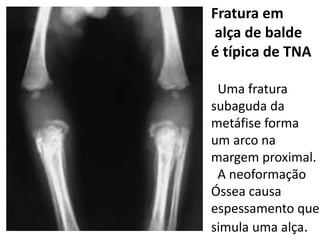 Fratura em
alça de balde
é típica de TNA
Uma fratura
subaguda da
metáfise forma
um arco na
margem proximal.
A neoformação
Óssea causa
espessamento que
simula uma alça.
 