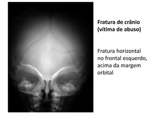 Fratura de crânio
(vítima de abuso)
Fratura horizontal
no frontal esquerdo,
acima da margem
orbital
 