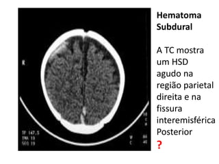 Hematoma
Subdural
A TC mostra
um HSD
agudo na
região parietal
direita e na
fissura
interemisférica
Posterior
?
 