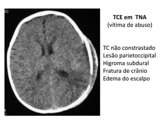 TCE em TNA
(vítima de abuso)
TC não constrastado
Lesão parietoccipital
Higroma subdural
Fratura de crânio
Edema do escalpo
 