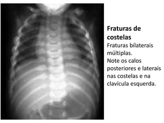 Fraturas de
costelas
Fraturas bilaterais
múltiplas.
Note os calos
posteriores e laterais
nas costelas e na
clavícula esquerda.
 