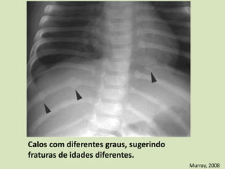 Calos com diferentes graus, sugerindo
fraturas de idades diferentes.
Murray, 2008
 